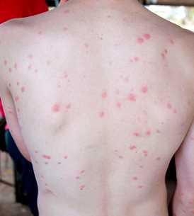 Von Kriebelmücken zerstochener Rücken eines jungen Mannes